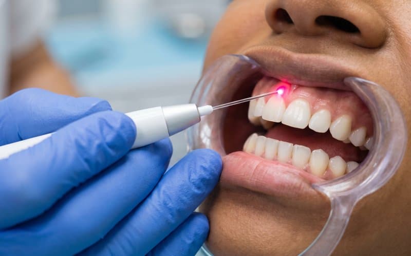 Diagram of a dental laser aimed at the gum around a tooth