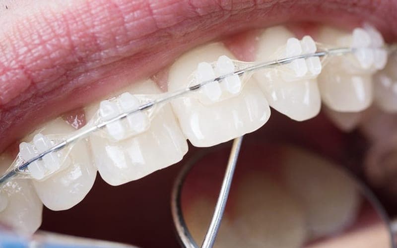 Clear ceramic braces on upper teeth