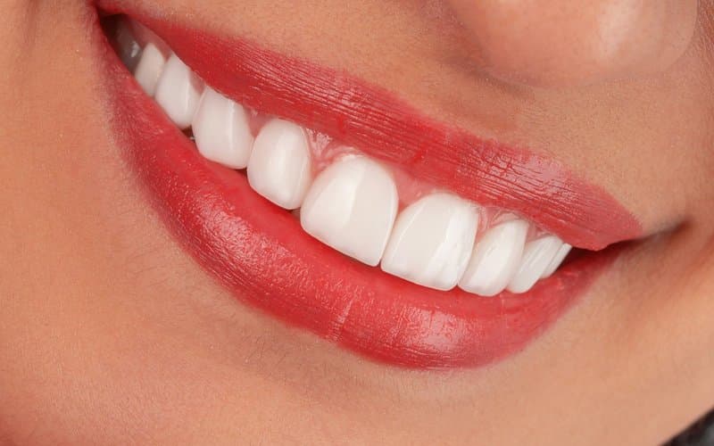 Two porcelain veneer shells