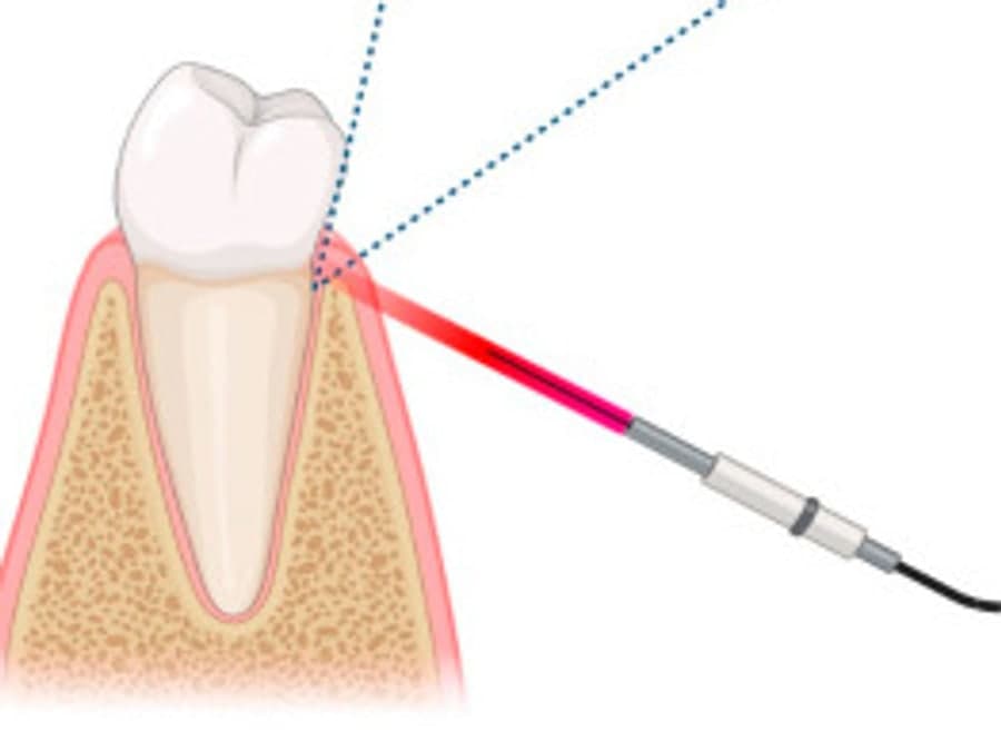 Illustration of a slim pen-shaped dental laser handpiece directing a soft beam at the gum line beside a tooth shown in cross-section.