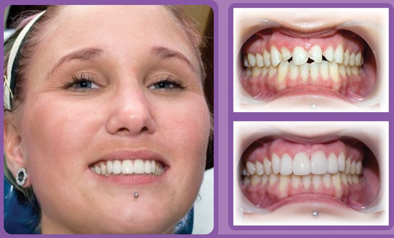 Patient A - before and after veneers treatment